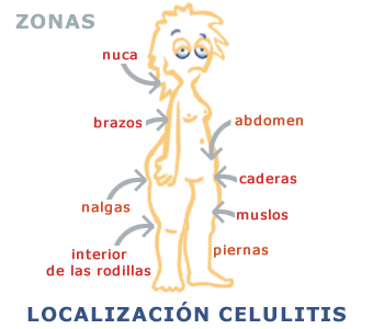 celulitis