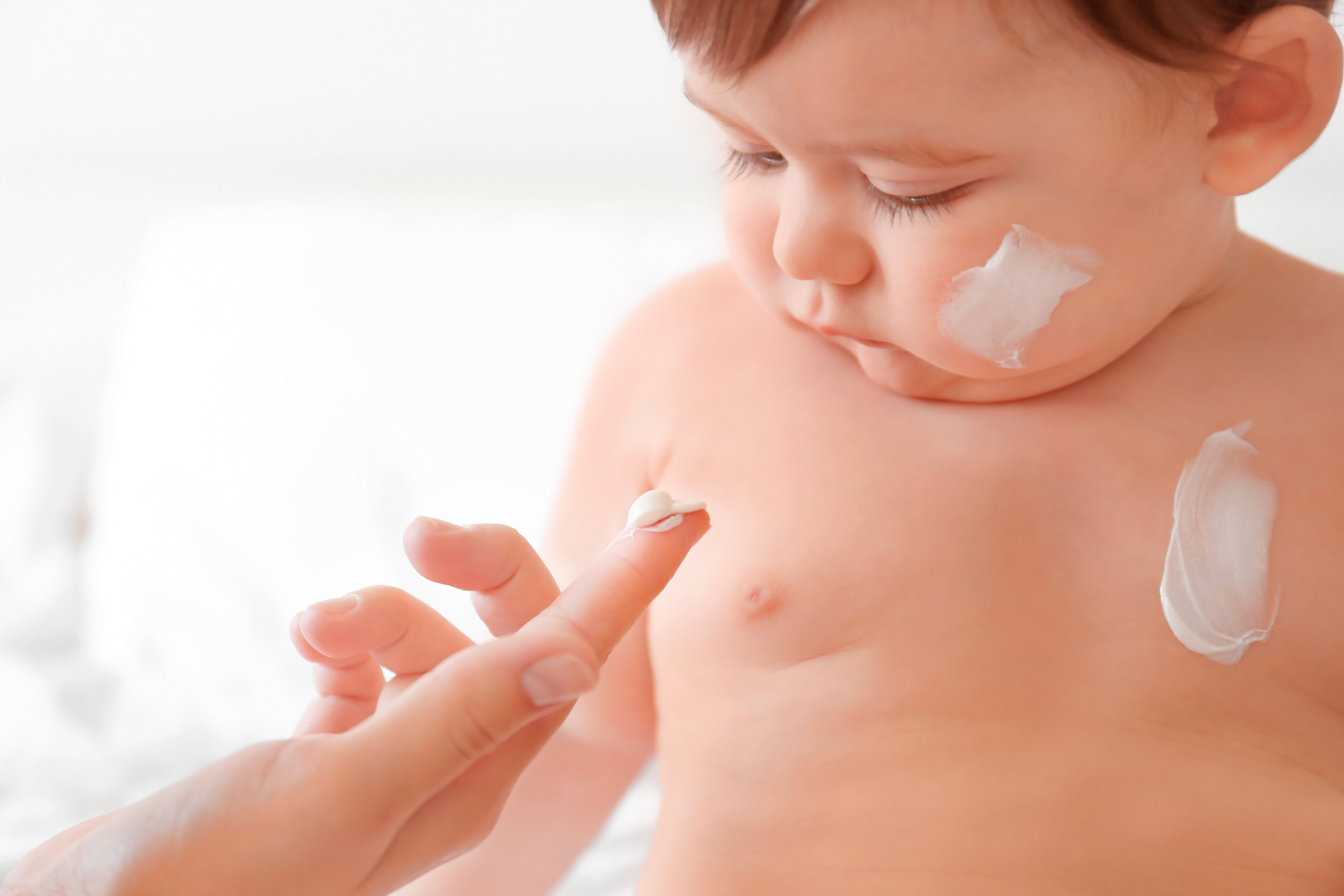 Dermatitis atópica infantil -