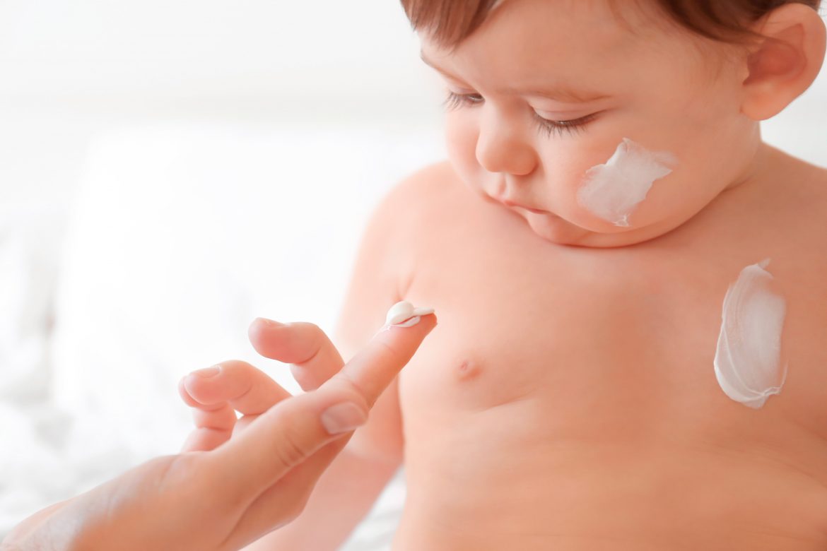 Dermatitis-atòpica-infantil