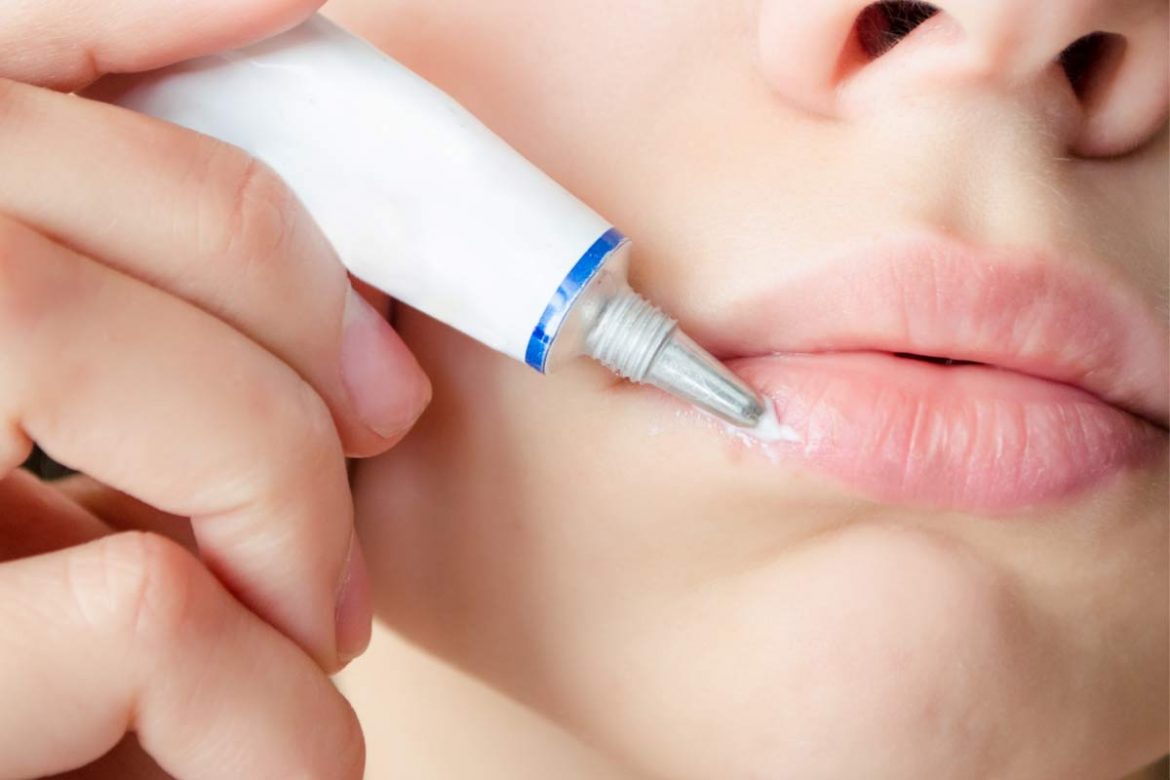 herpes-labial
