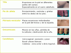 micosis_es